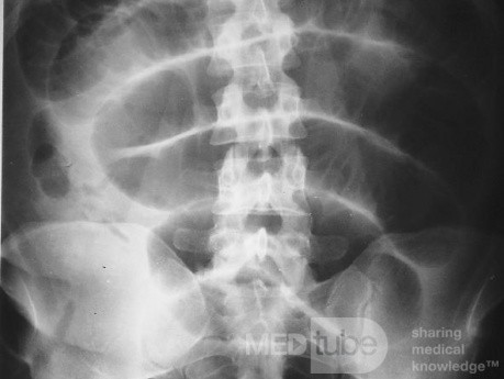 Gastrointestinal Tract Obstruction