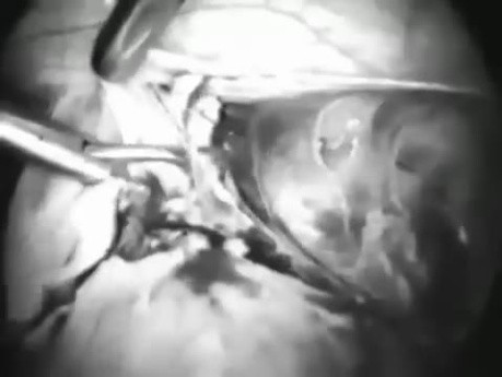 Laparoscopic hysterectomy by Kurt Semm