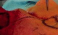 Nasolabial Island Flap - A 89-year-old Male
