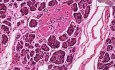 Hyalinized islets - Histopathology of pancreas