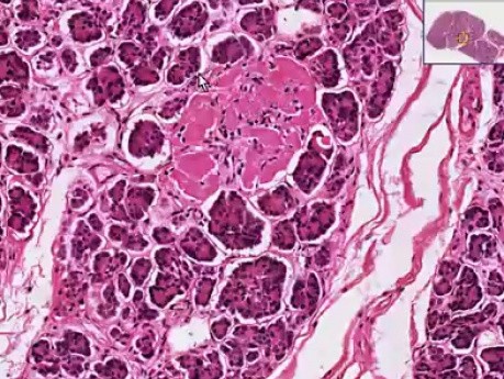 Hyalinized islets - Histopathology of pancreas