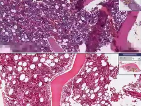 Bone marrow adenocarcinoma