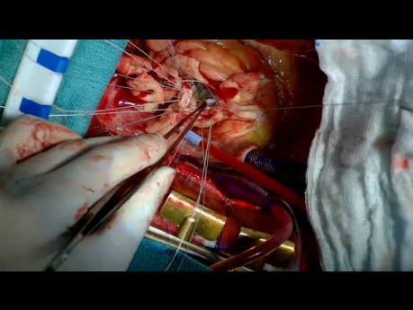 Aortic Root Replacement with a Mechanical Valved Conduit to Treat Aortic Root Aneurysm