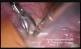 Laparoscopic Adnexectomy on Border Line Ovarian Tumor