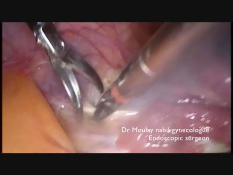 Laparoscopic Adnexectomy on Border Line Ovarian Tumor