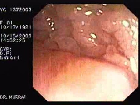 Tubulo - Villous Adenoma - Endoscopy (2 of 28)