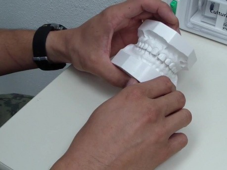 Orthodontic Case #2 - Review Of Chief Complaint W/ Models