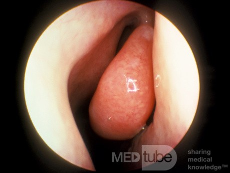 Vasomotor Rhinitis