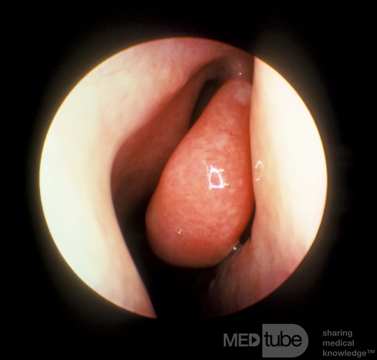 Vasomotor Rhinitis