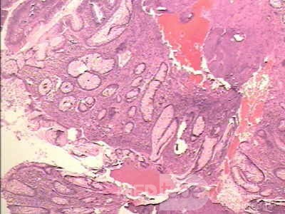 Malign Polyp (6 of 8)