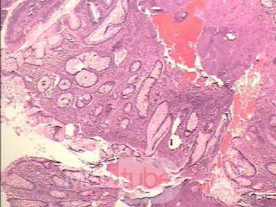 Malign Polyp (6 of 8)