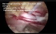 Biportal Endoscopic Disectomy