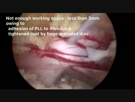 Biportal Endoscopic Disectomy