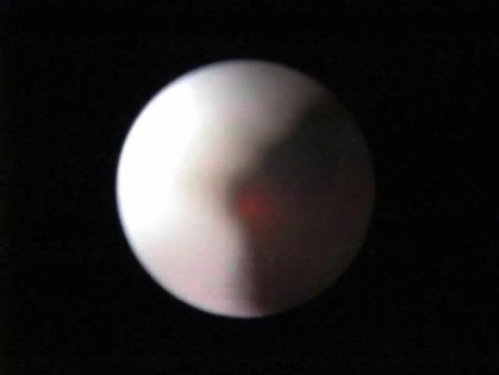 Laser Ureteroscopy - Part 2