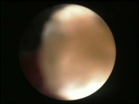 PCNL - Flexible Nephroscope