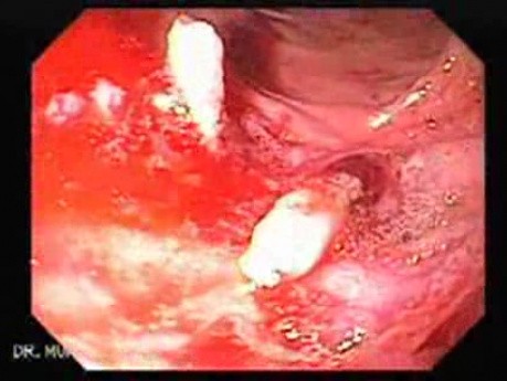 Duodenal Ulcer and Bleeding (23 of 23)