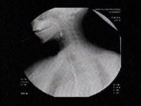 Esophageal Achalasia - Detection of Typical Problems 