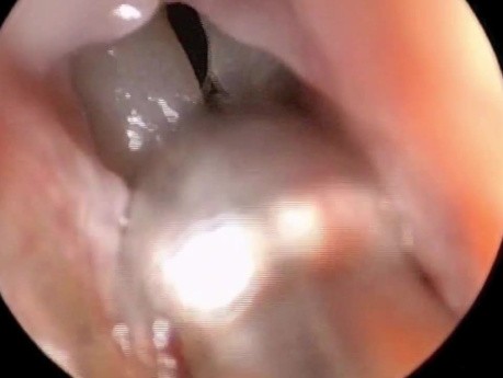 Balloon Dilation of Frontal Sinus under Local Anesthesia