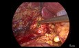 Laparoscopic Common Bile Duct Exploration and Drainage of Liver Abcess