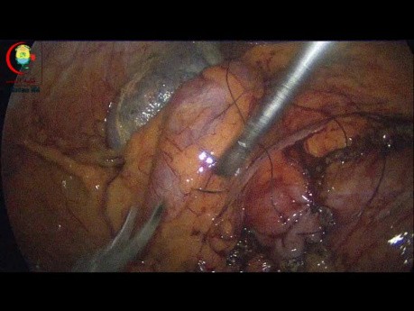 Thermal Injuries of the Bowel Should be Covered with Transverse Seromuscular Sutures