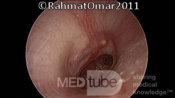 Eardrum Perforation in Inactive Stage