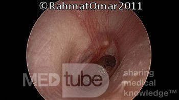 Eardrum Perforation in Inactive Stage