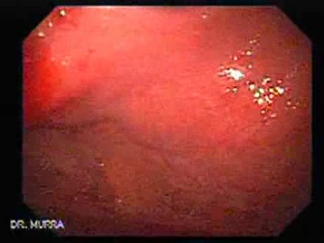 Upper Gastrointestinal Bleeding (2 of 3)