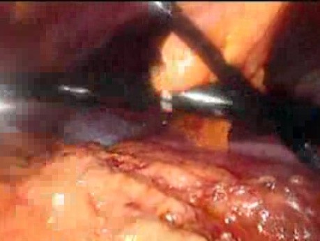 Gastrointestinal Stromal Tumor - GIST (29 of 65)