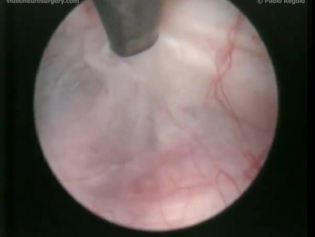 3Rd Ventriculostomy - Using Fogarty Balloon