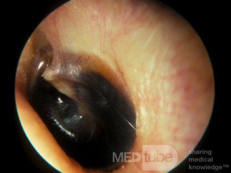 Hemotympanum