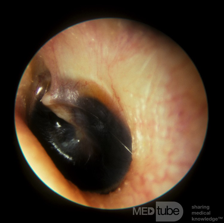 Hemotympanum