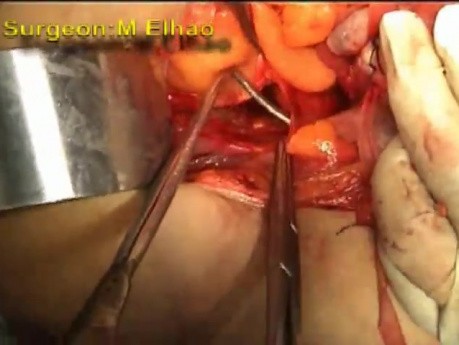 Congenital Prolapse of the Uterus - Sling Procedure, Part 1