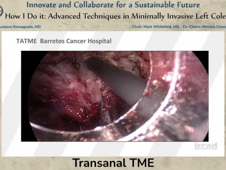 Transanal TME