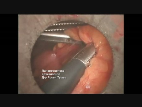 Laparoscopic Adhesiolysis