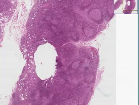 Toxoplasmosis