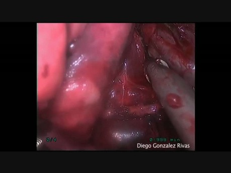 Uniportal VATS Right Anterobasal Segmentectomy (S8)