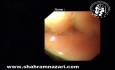 Endoscopy in Large Hiatal Hernia with Intrathoracic Stomach