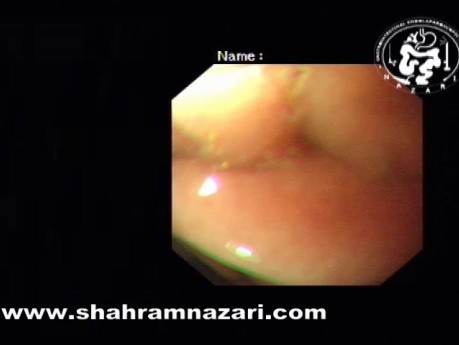 Endoscopy in Large Hiatal Hernia with Intrathoracic Stomach