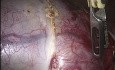 Huge Teratoma Cystectomy
