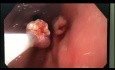 Endoscopic polypectomy