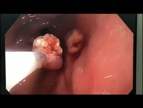Endoscopic polypectomy