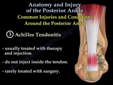Posterior Ankle, Anatomy And Injury 