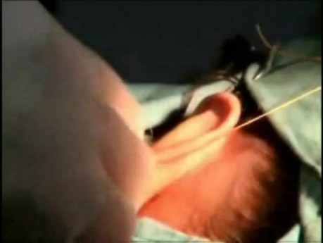 Scarless Auriculoplasty