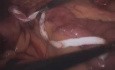 Laparoscopic Gastric Bypass