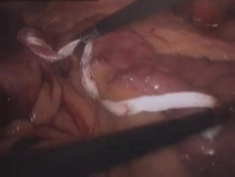 Laparoscopic Gastric Bypass