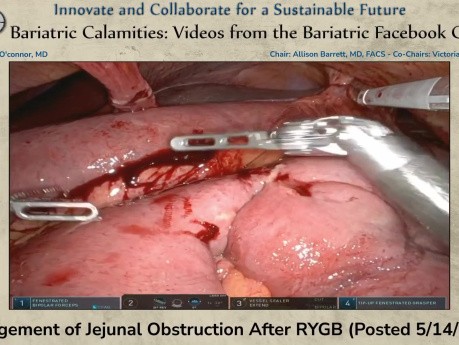Management of Jejunal Obstruction After RYGB