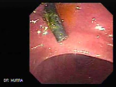 Adenocarcinoma of the Gallbladder (2 of 3)