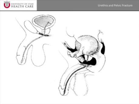 Pelvic Fracture Urethral Injuries