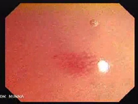 Magnifying Colonoscopy (1 of 2)