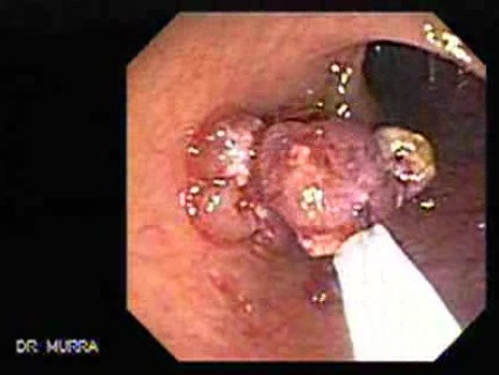 Stalked Polyp - Polypectomy (5 of 6)